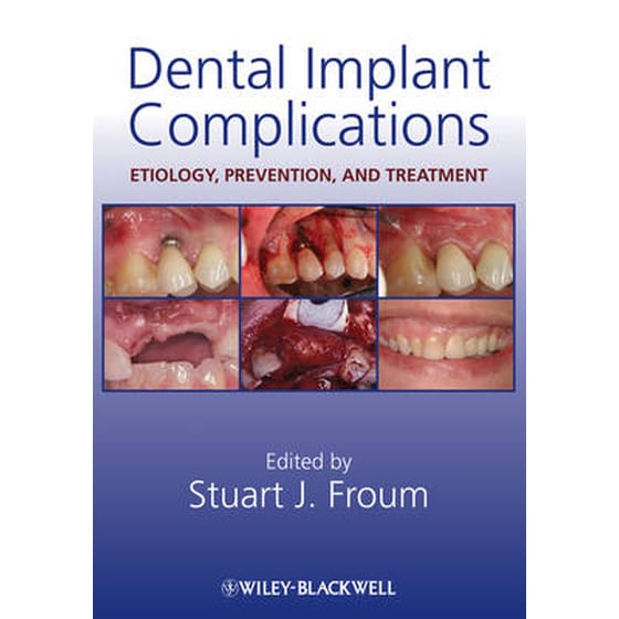 Dental Implant Complications image 0