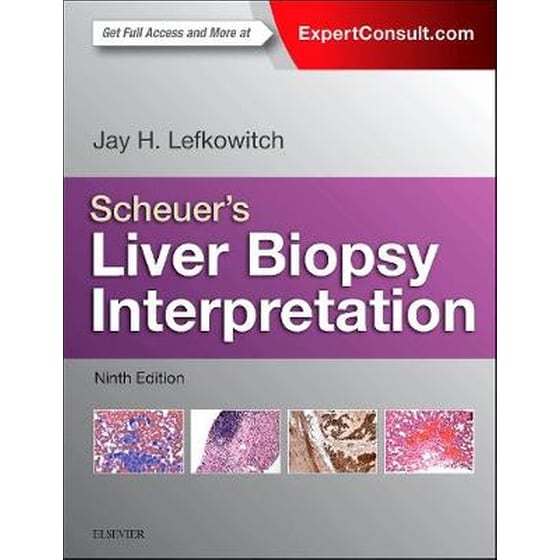 Scheuer's Liver Biopsy Interpretation image 0