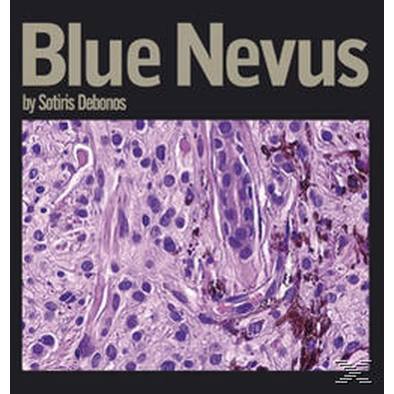 Blue Nevus
