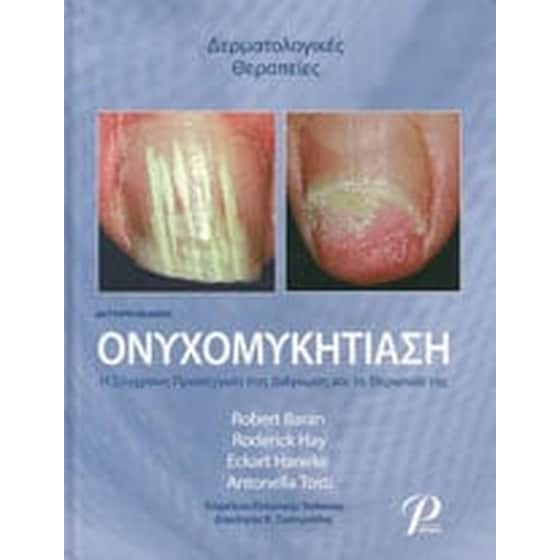 Ονυχομυκητίαση image 0